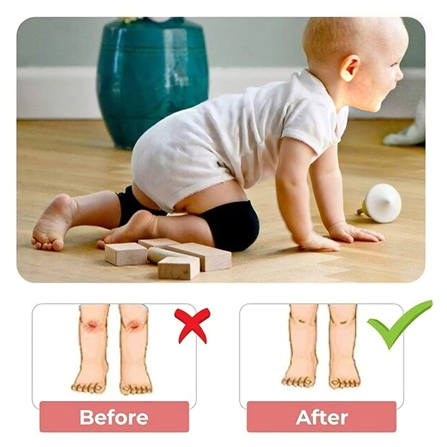1 Pairs Baby Knee Pads for Crawling (1 Pair / 6 Cm) - Shivani Jaswal 1 Pairs Baby Knee Pads for Crawling (1 Pair / 6 Cm)